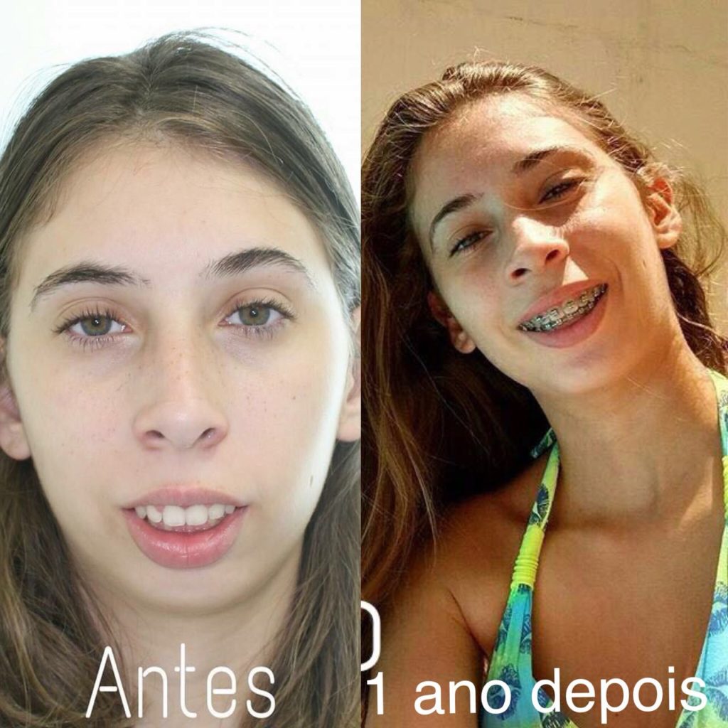 Antes e depois da ortodontia